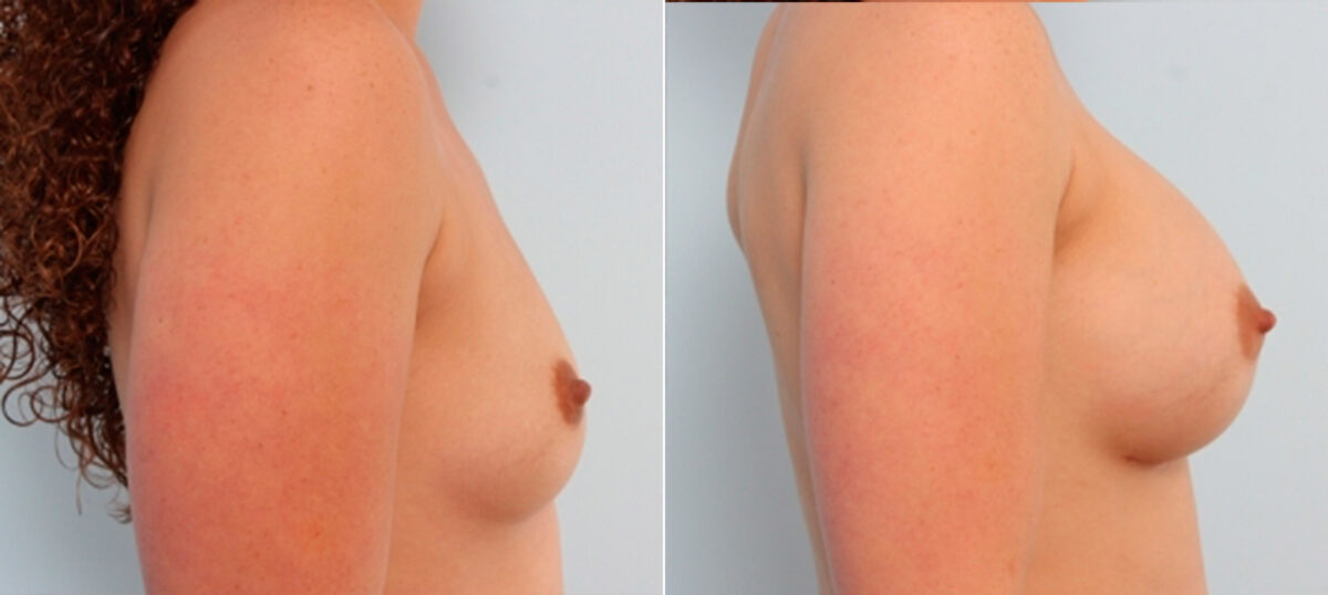 Breast Augmentation before and after photos in Houston, TX, Patient 24666