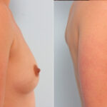 Breast Augmentation before and after photos in Houston, TX, Patient 24666