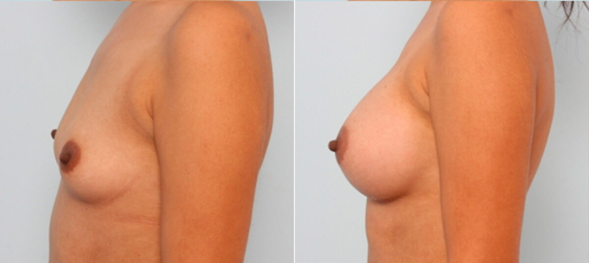 Breast Augmentation before and after photos in Houston, TX, Patient 24677