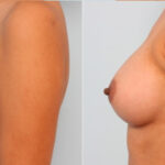 Breast Augmentation before and after photos in Houston, TX, Patient 24677