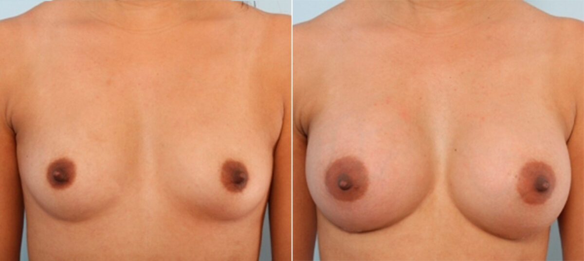 Breast Augmentation before and after photos in Houston, TX, Patient 24677