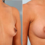 Breast Augmentation before and after photos in Houston, TX, Patient 24677