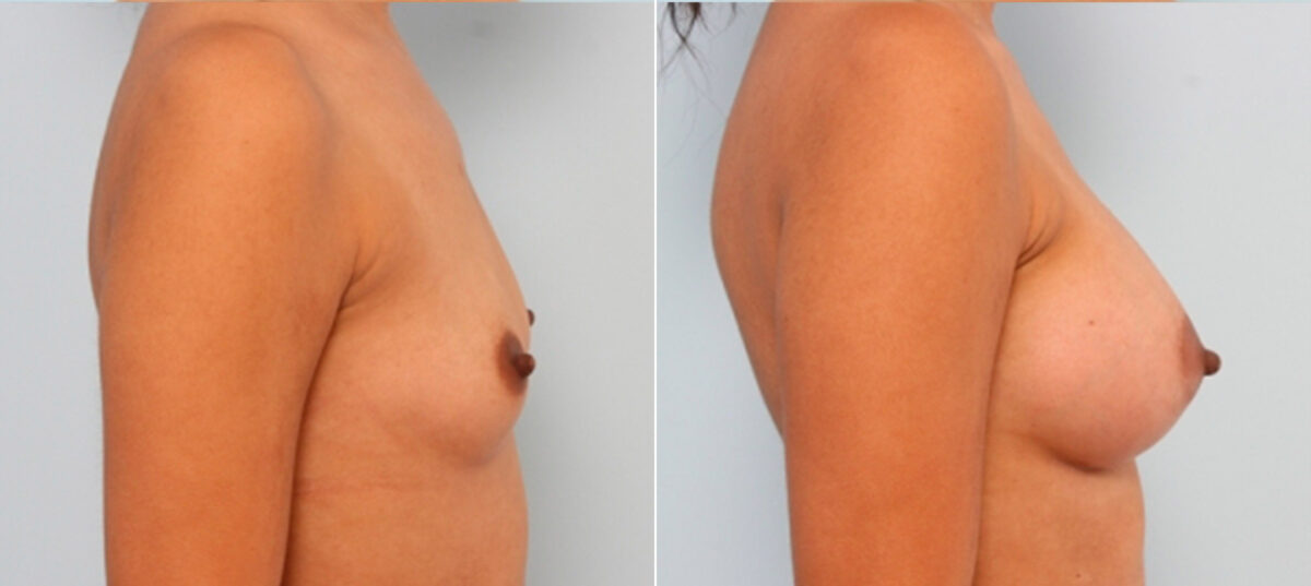 Breast Augmentation before and after photos in Houston, TX, Patient 24677