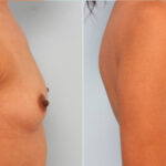 Breast Augmentation before and after photos in Houston, TX, Patient 24677