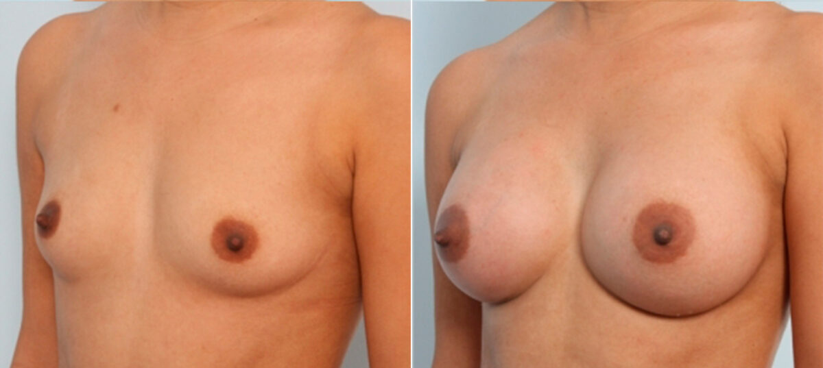 Breast Augmentation before and after photos in Houston, TX, Patient 24677