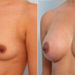 Breast Augmentation before and after photos in Houston, TX, Patient 24677