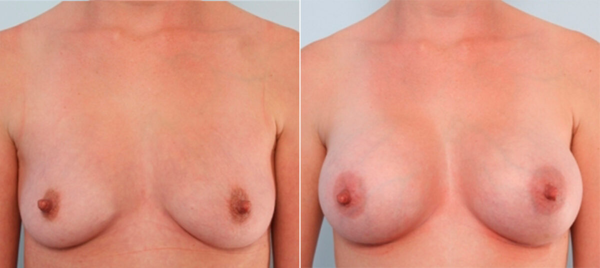 Breast Augmentation before and after photos in Houston, TX, Patient 24688