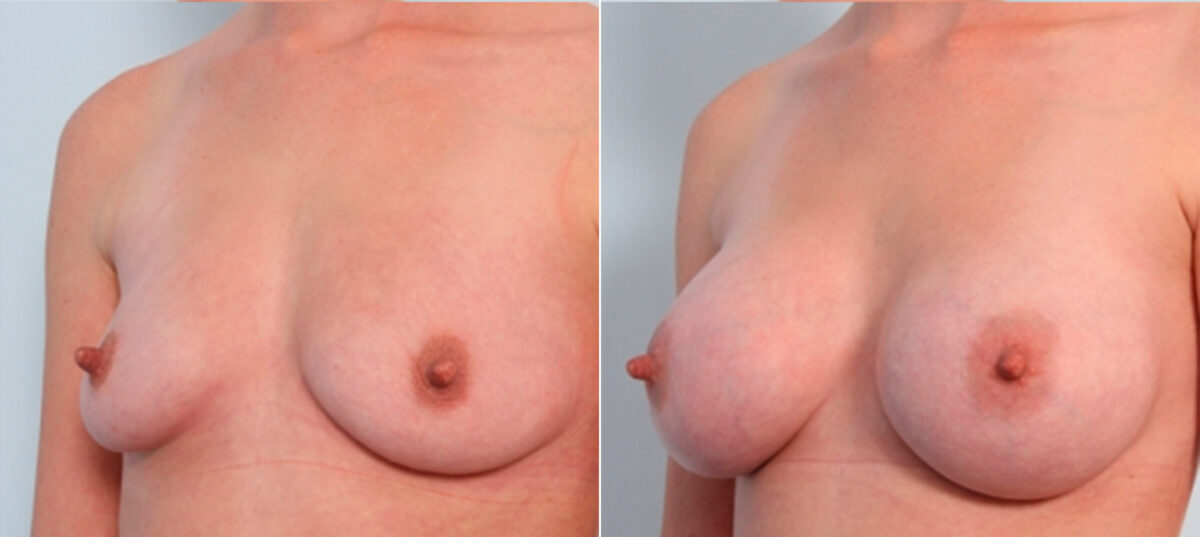 Breast Augmentation before and after photos in Houston, TX, Patient 24688