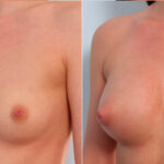 Breast Augmentation before and after photos in Houston, TX, Patient 24699