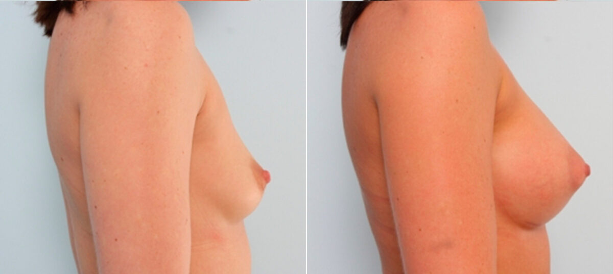 Breast Augmentation before and after photos in Houston, TX, Patient 24699