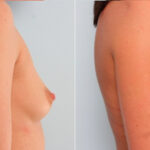 Breast Augmentation before and after photos in Houston, TX, Patient 24699