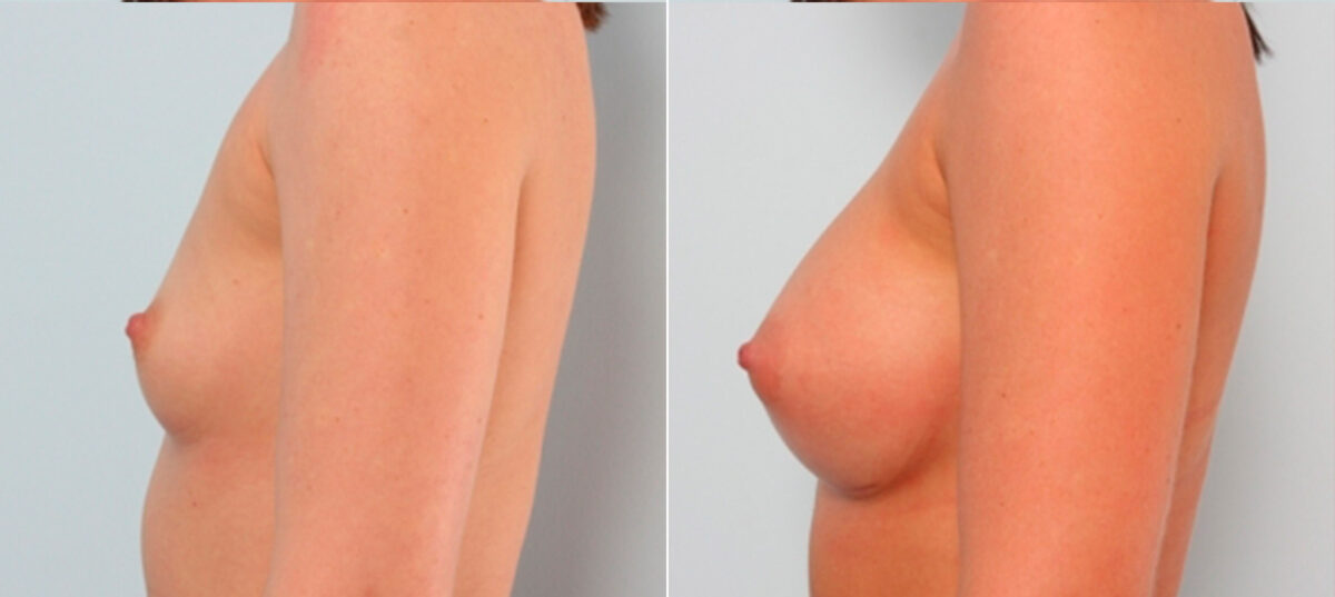 Breast Augmentation before and after photos in Houston, TX, Patient 24699