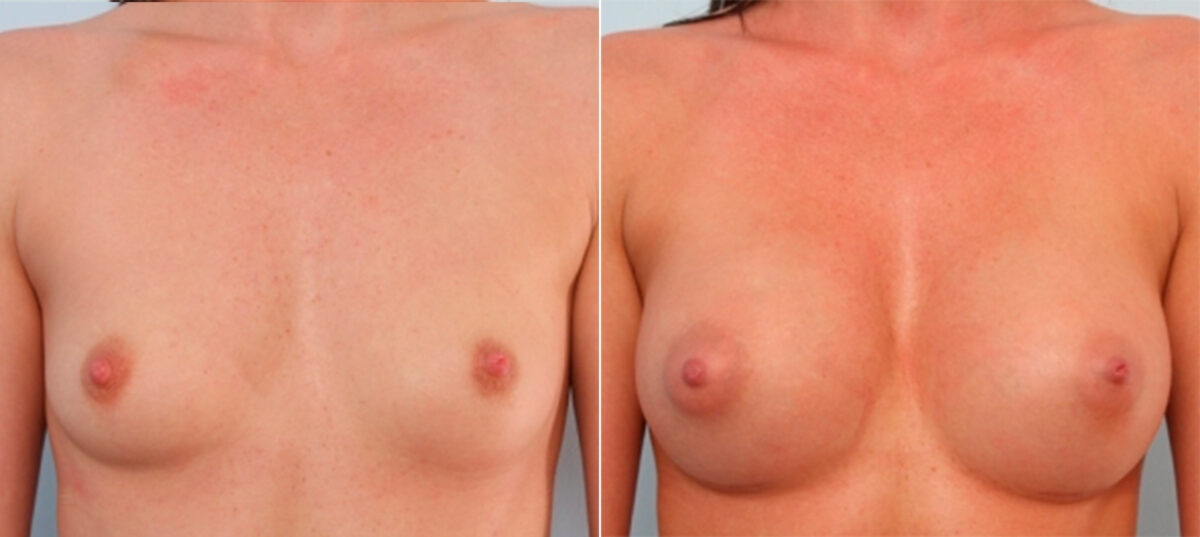 Breast Augmentation before and after photos in Houston, TX, Patient 24699