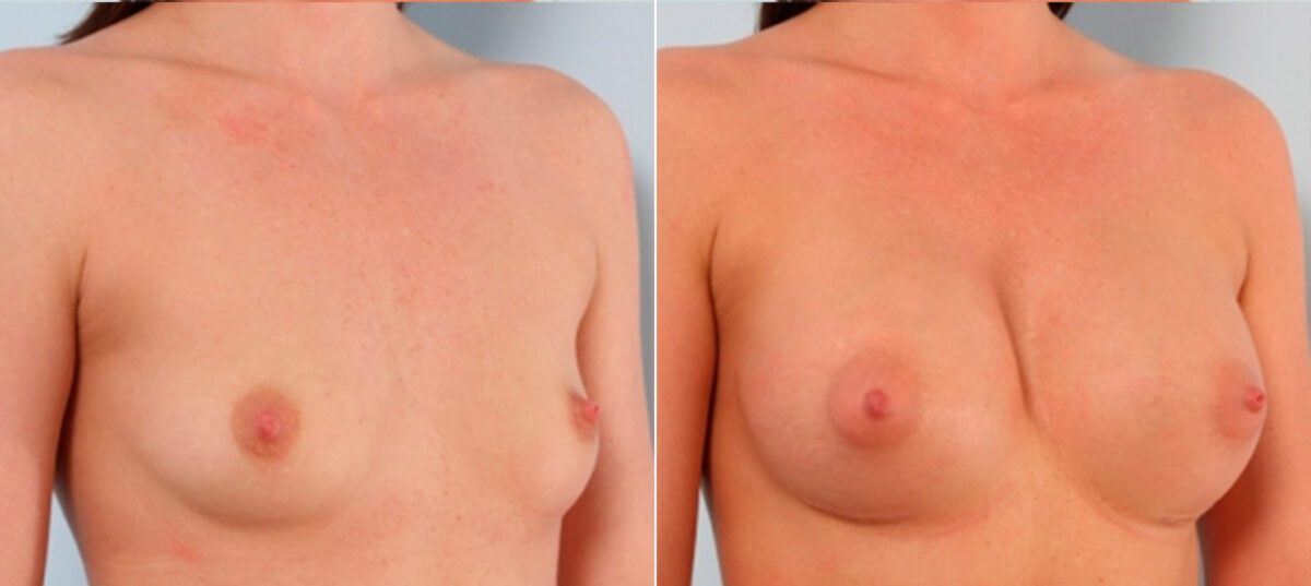 Breast Augmentation before and after photos in Houston, TX, Patient 24699