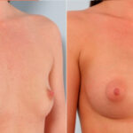 Breast Augmentation before and after photos in Houston, TX, Patient 24699