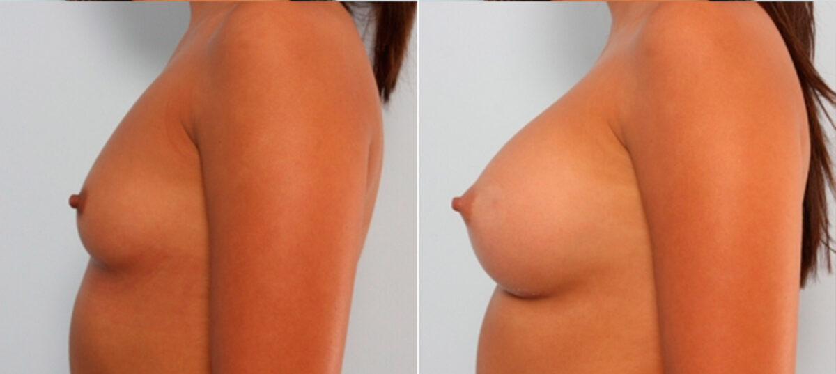 Breast Augmentation before and after photos in Houston, TX, Patient 24710