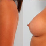 Breast Augmentation before and after photos in Houston, TX, Patient 24710