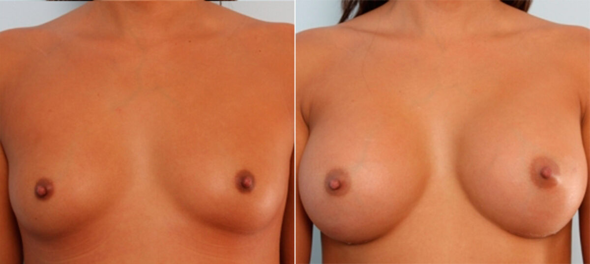 Breast Augmentation before and after photos in Houston, TX, Patient 24710