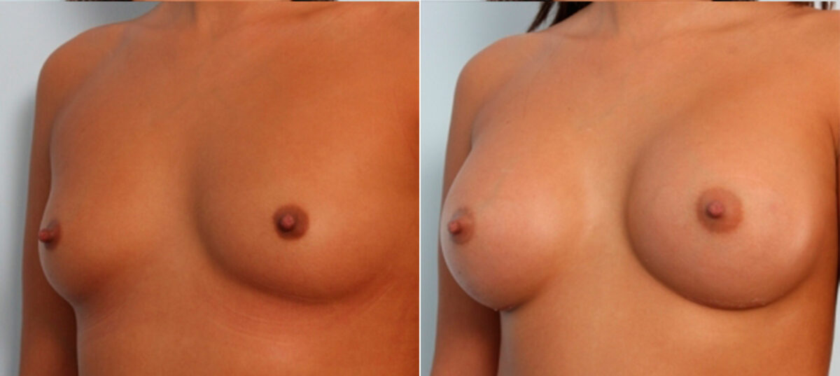 Breast Augmentation before and after photos in Houston, TX, Patient 24710