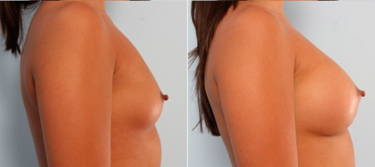 Breast Augmentation before and after photos in Houston, TX, Patient 24710