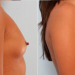 Breast Augmentation before and after photos in Houston, TX, Patient 24710