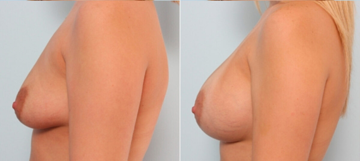 Breast Augmentation before and after photos in Houston, TX, Patient 24721