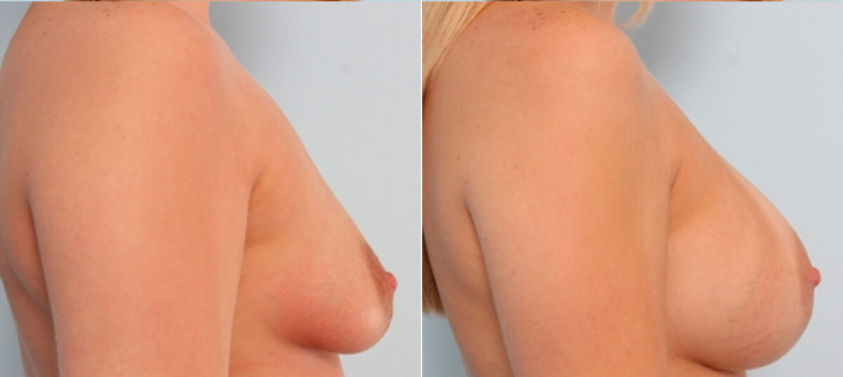 Breast Augmentation before and after photos in Houston, TX, Patient 24721