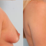 Breast Augmentation before and after photos in Houston, TX, Patient 24721