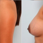 Breast Augmentation before and after photos in Houston, TX, Patient 24732