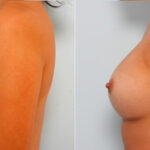 Breast Augmentation before and after photos in Houston, TX, Patient 24754