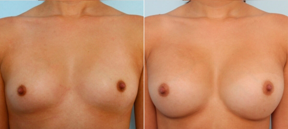 Breast Augmentation before and after photos in Houston, TX, Patient 24754