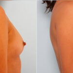 Breast Augmentation before and after photos in Houston, TX, Patient 24754