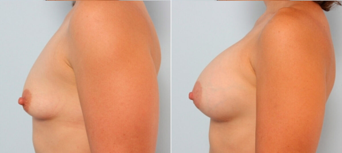 Breast Augmentation before and after photos in Houston, TX, Patient 24765