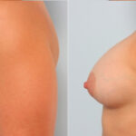 Breast Augmentation before and after photos in Houston, TX, Patient 24765