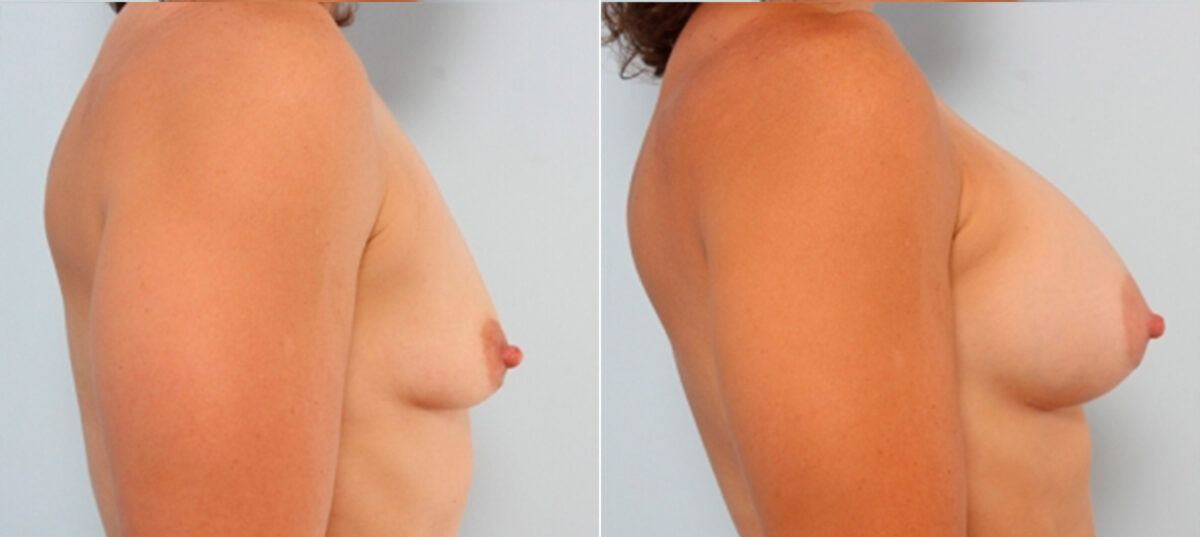 Breast Augmentation before and after photos in Houston, TX, Patient 24765