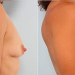 Breast Augmentation before and after photos in Houston, TX, Patient 24765