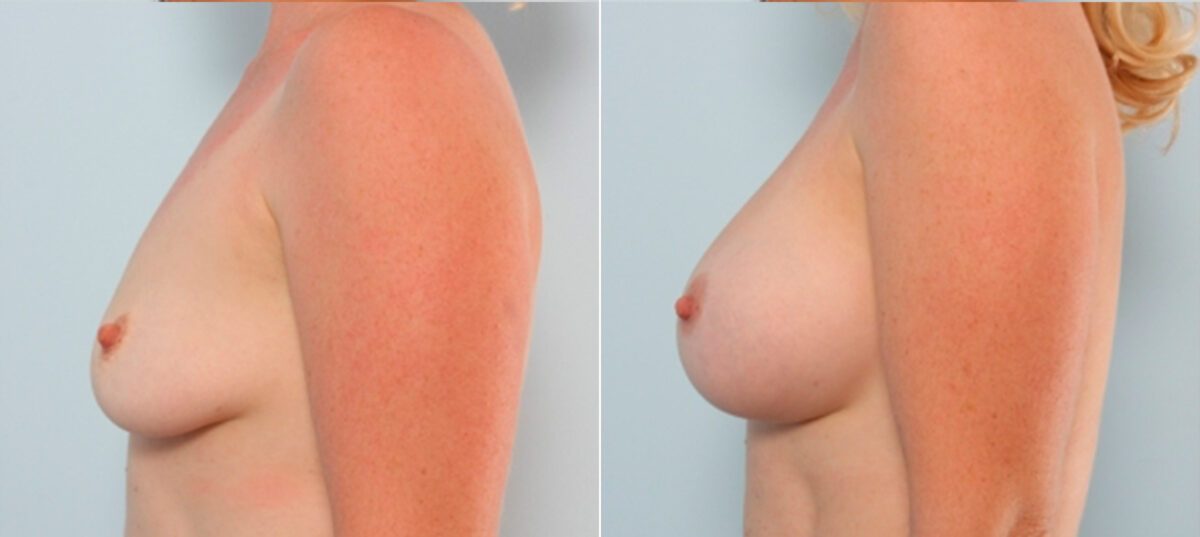 Breast Augmentation before and after photos in Houston, TX, Patient 24776
