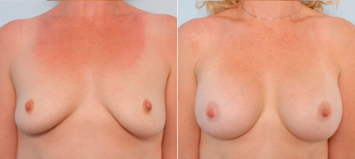 Breast Augmentation before and after photos in Houston, TX, Patient 24776