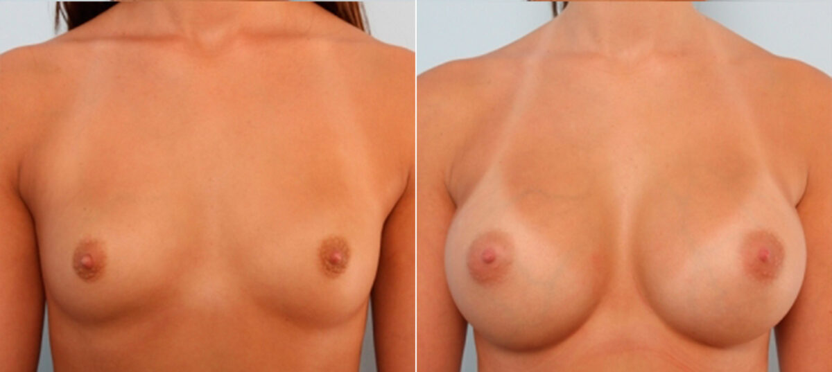 Breast Augmentation before and after photos in Houston, TX, Patient 24787