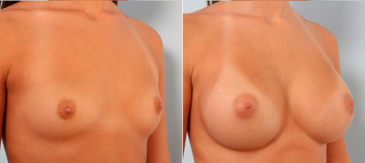 Breast Augmentation before and after photos in Houston, TX, Patient 24787