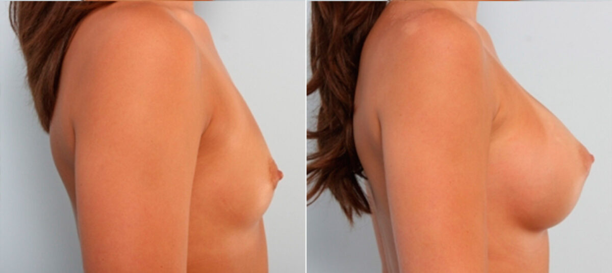 Breast Augmentation before and after photos in Houston, TX, Patient 24787