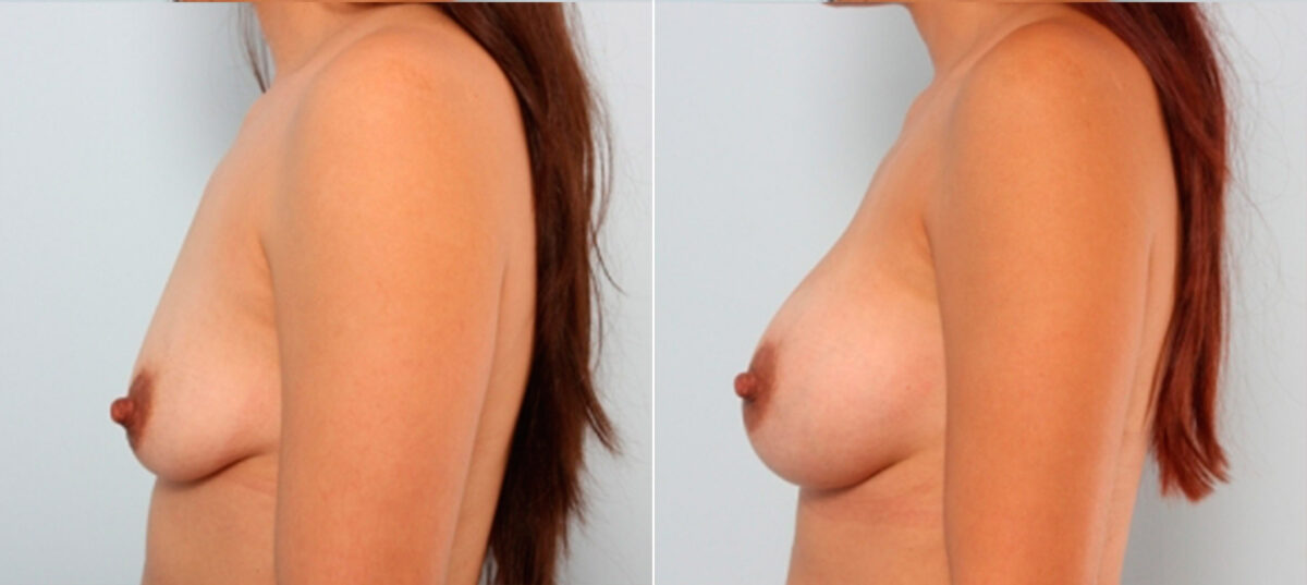 Breast Augmentation before and after photos in Houston, TX, Patient 24798