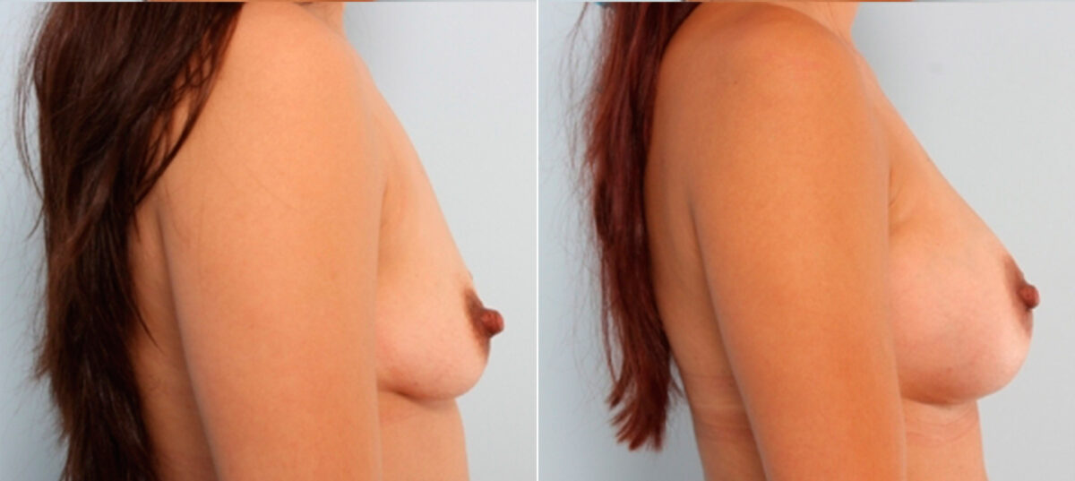 Breast Augmentation before and after photos in Houston, TX, Patient 24798