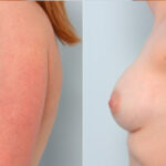 Breast Augmentation before and after photos in Houston, TX, Patient 24809