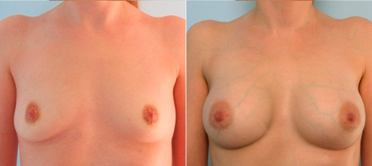 Breast Augmentation before and after photos in Houston, TX, Patient 24809