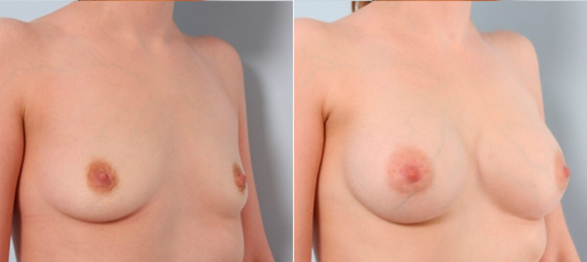 Breast Augmentation before and after photos in Houston, TX, Patient 24809