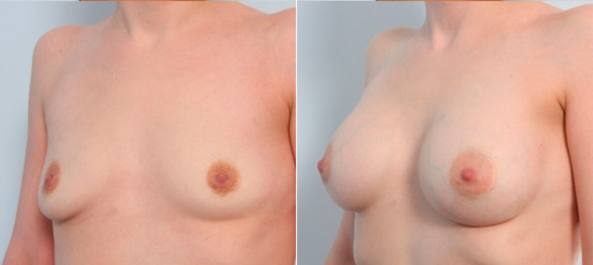Breast Augmentation before and after photos in Houston, TX, Patient 24809