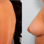 Breast Augmentation before and after photos in Houston, TX, Patient 24820