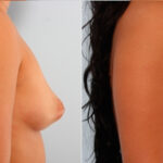 Breast Augmentation before and after photos in Houston, TX, Patient 24820