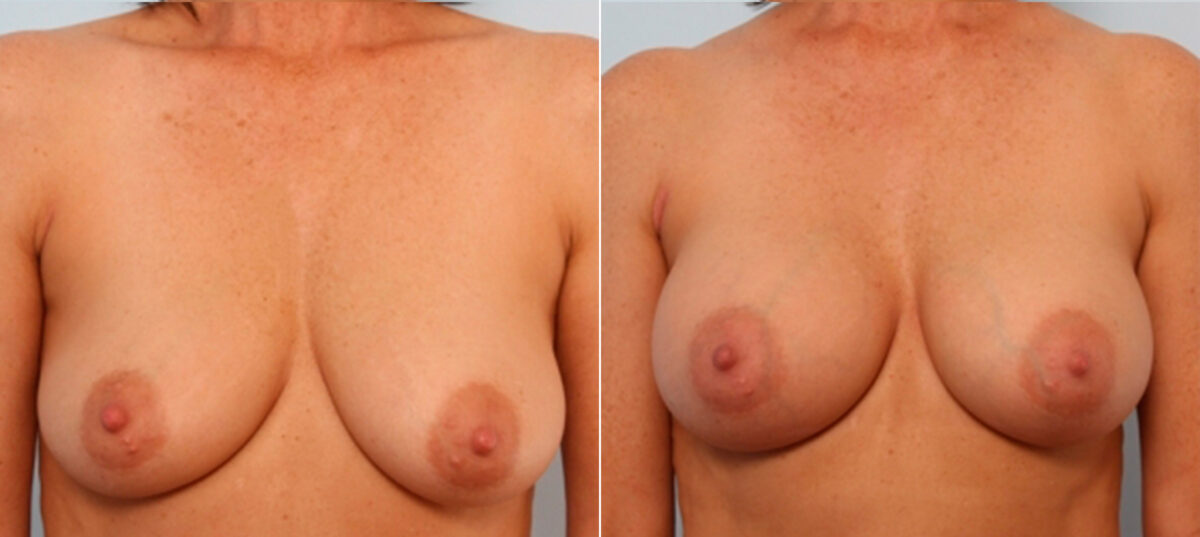 Breast Augmentation before and after photos in Houston, TX, Patient 24831